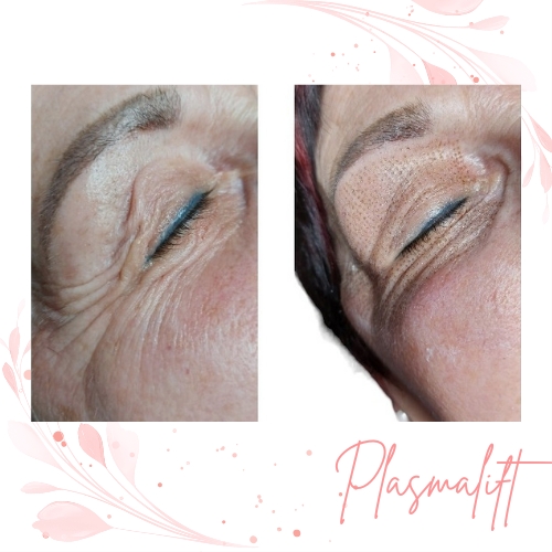 Plasmalift behandeling voor huidverstrakking bij Beauté Huidexpertise Ieper