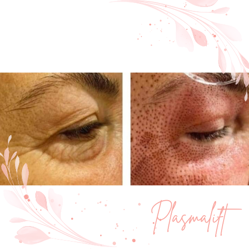Plasmalift behandeling voor huidverstrakking bij Beauté Huidexpertise Ieper