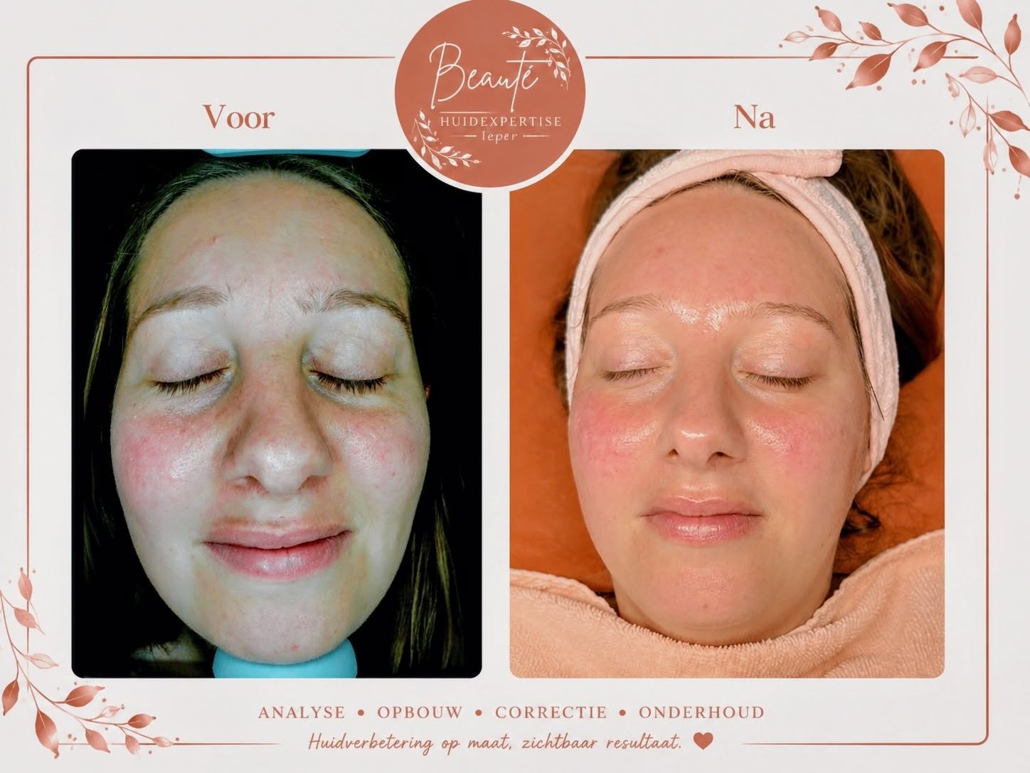 Voor en na resultaat van een HydraFacial behandeling bij Beauté Huidexpertise Ieper