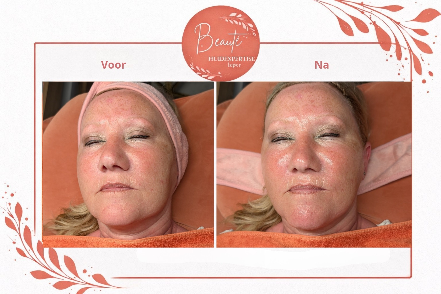 Voor en na resultaat van een HydraFacial behandeling bij Beauté Huidexpertise Ieper