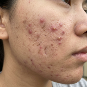 Close-up of cheek with red inflamed acne lesions, pustules, and scars
