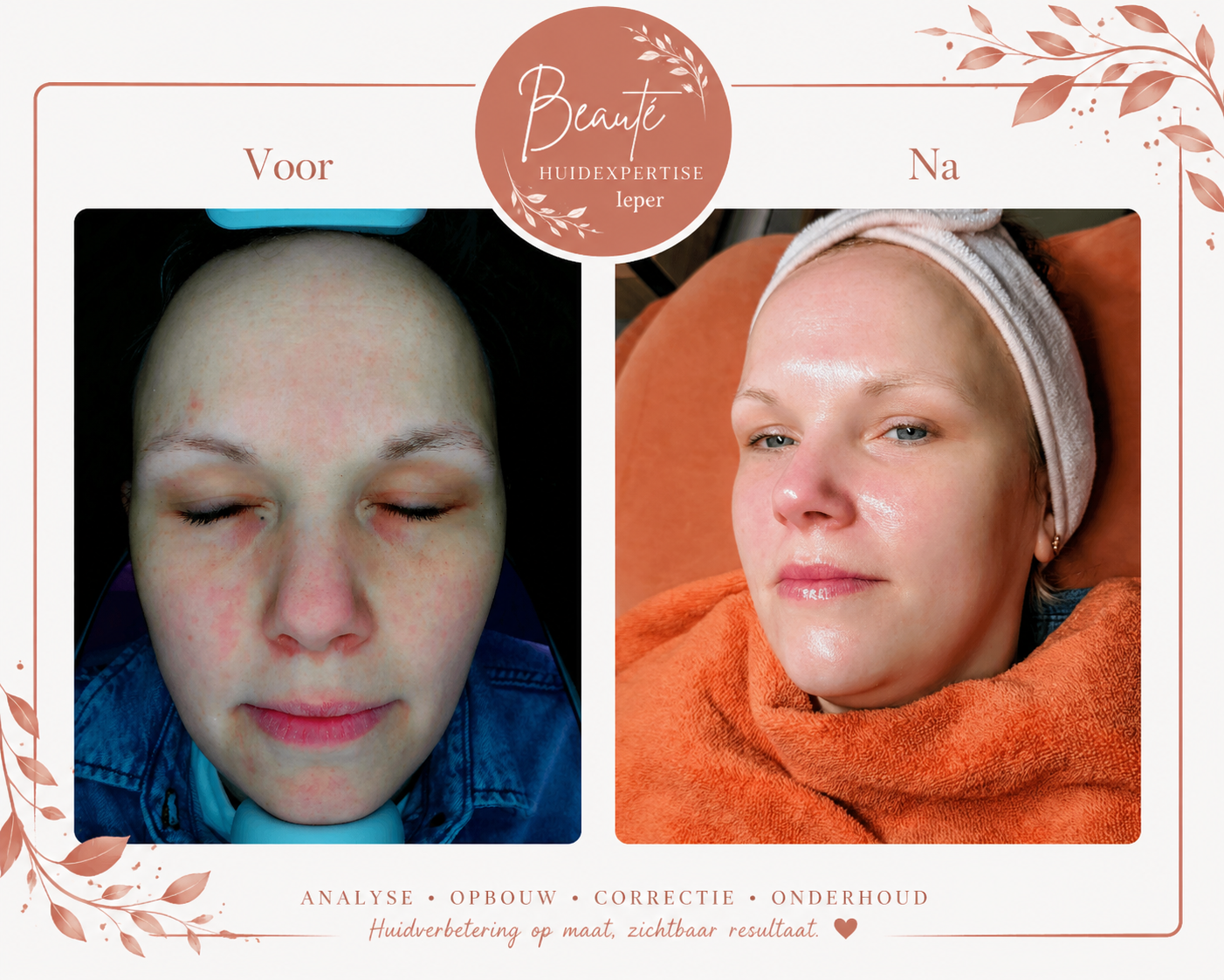 Voor en na resultaat van een HydraFacial behandeling bij Beauté Huidexpertise Ieper